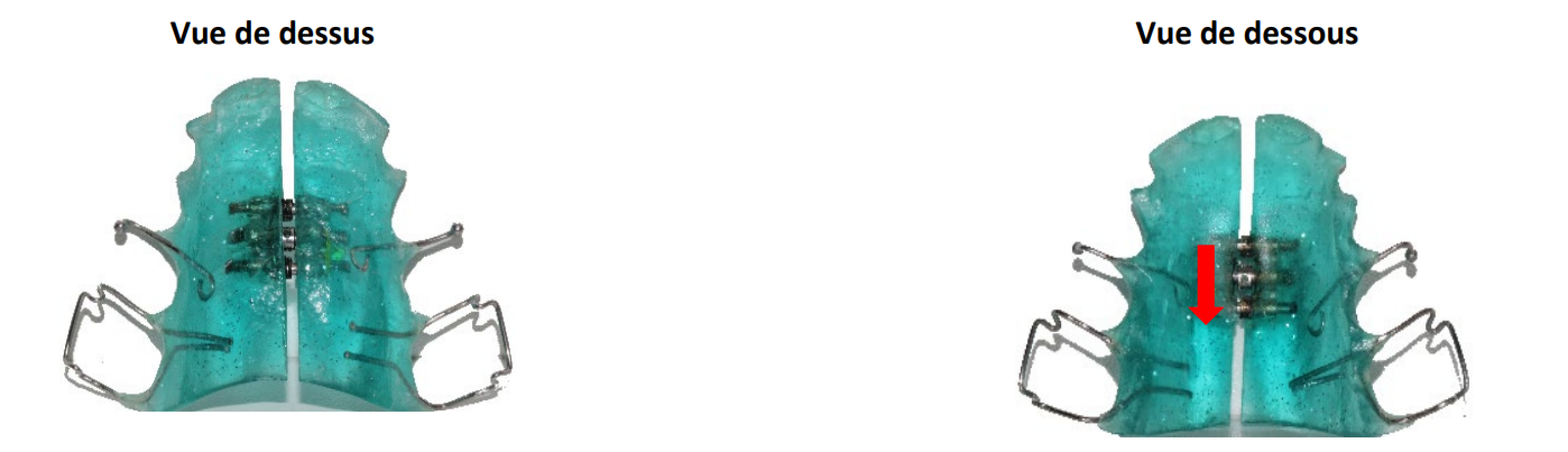 Comment activer mon vérin médian ?