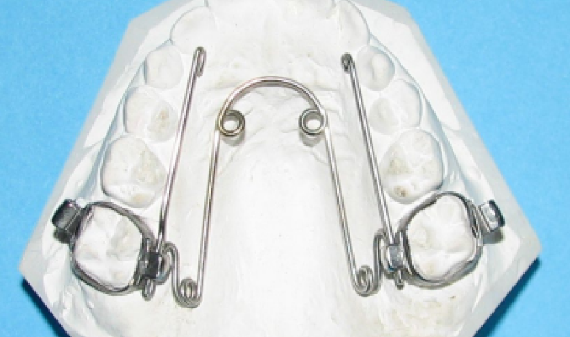 Comment prendre soin de mon quad-hélix ?